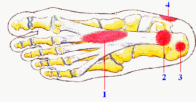 Traumi del Podista: spina calcaneare e fascite plantare. I consigli del Dott. Castellani