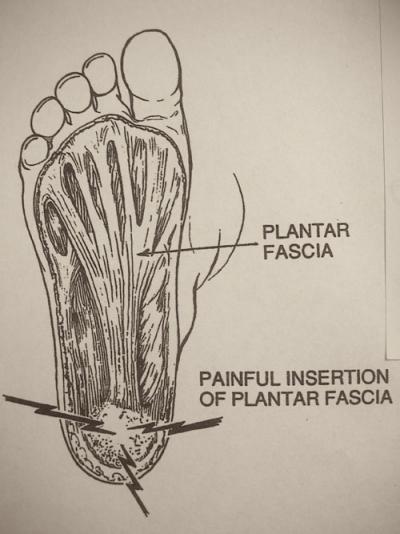 La fascite plantare spiegata dal dott. Ernesto Ciravegna