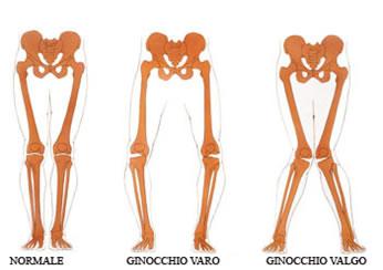 Ginocchio: anatomia, patologie frequenti e possibili rimedi