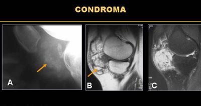 Condromi: cause, sintomi e possibili rimedi