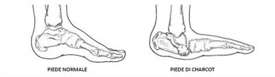 Il piede di Charcot: cause, sintomi e possibili rimedi