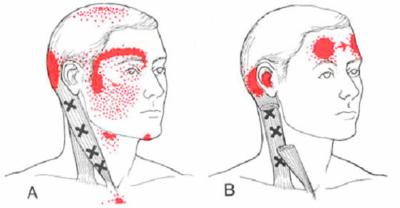 Sindrome cervicale di Barré-Lieou, ecco di cosa si tratta.