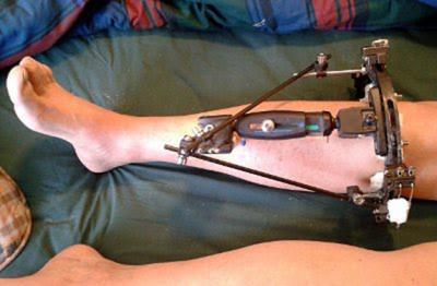 Frattura della tibia: le cause, i sintomi e i rimedi utili