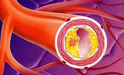 Cos'è l’arteriopatia obliterante? Consulta l’articolo...