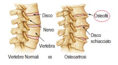 Sai cosa sono gli osteofiti? Cause e sintomi in questo articolo