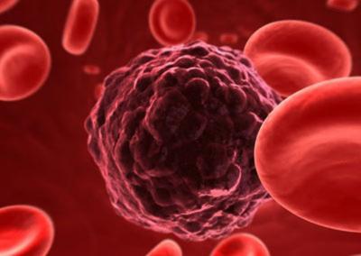 Sai cos’è la trombosi venosa profonda? Consulta il nostro articolo..