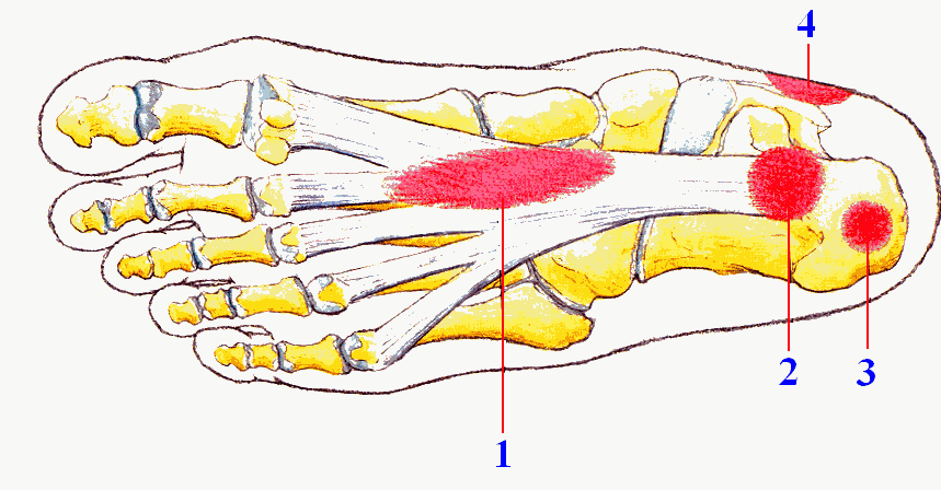 Traumi del Podista: spina calcaneare e fascite plantare. I consigli del Dott. Castellani