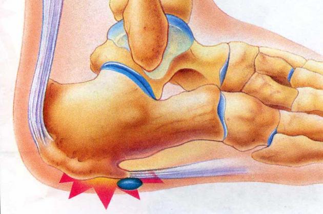 Cos'è la spina calcaneare? I consigli del Dott. Ciravegna