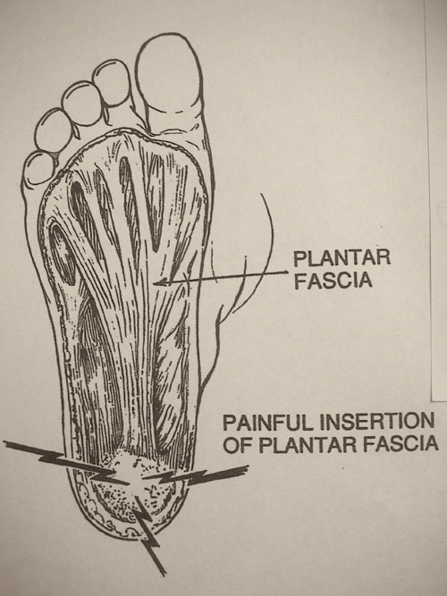 La fascite plantare spiegata dal dott. Ernesto Ciravegna