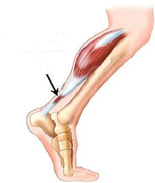 Riabilitazione dopo una lesione articolare, muscolare o una tendinite