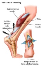 Traumi del podista: infiammazione del tendine di Achille
