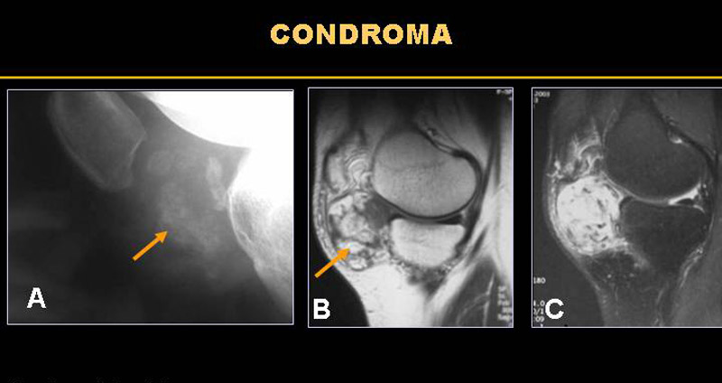 Condromi: cause, sintomi e possibili rimedi