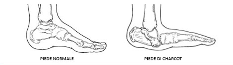 Il piede di Charcot: cause, sintomi e possibili rimedi