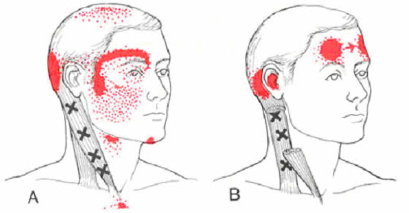 Sindrome cervicale di Barré-Lieou, ecco di cosa si tratta.