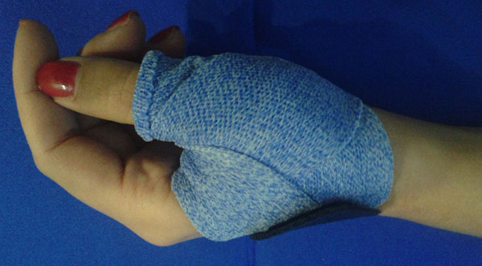 Rizoartrosi: cause, i sintomi frequenti e le possibili cure