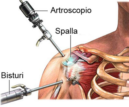 La patologia della spalla congelata: in questo articolo spieghiamo le cause, i sintomi più frequenti e le cure..