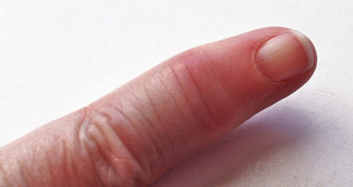 L’artrite psoriasica: cause, sintomi frequenti e trattamenti..