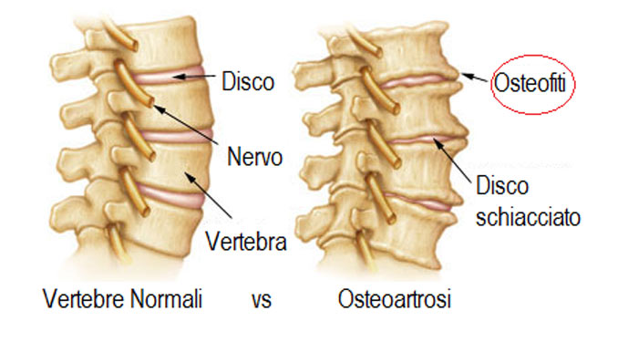 Sai cosa sono gli osteofiti? Cause e sintomi in questo articolo