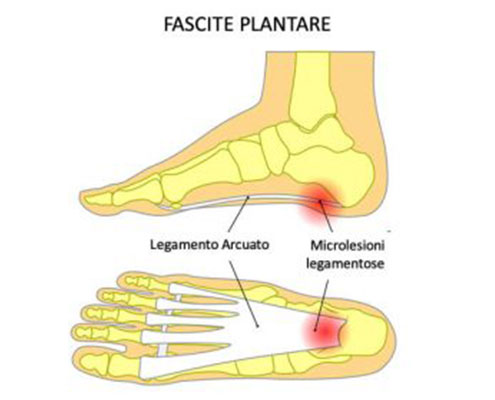 Solette Noene per trattare la fascite plantare
